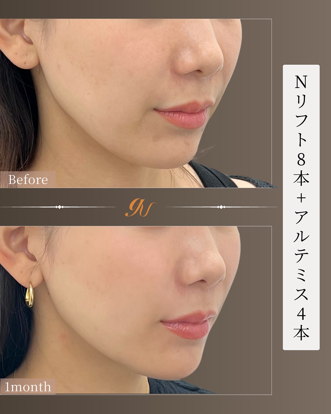 口横ぽにょ改善 Before/After