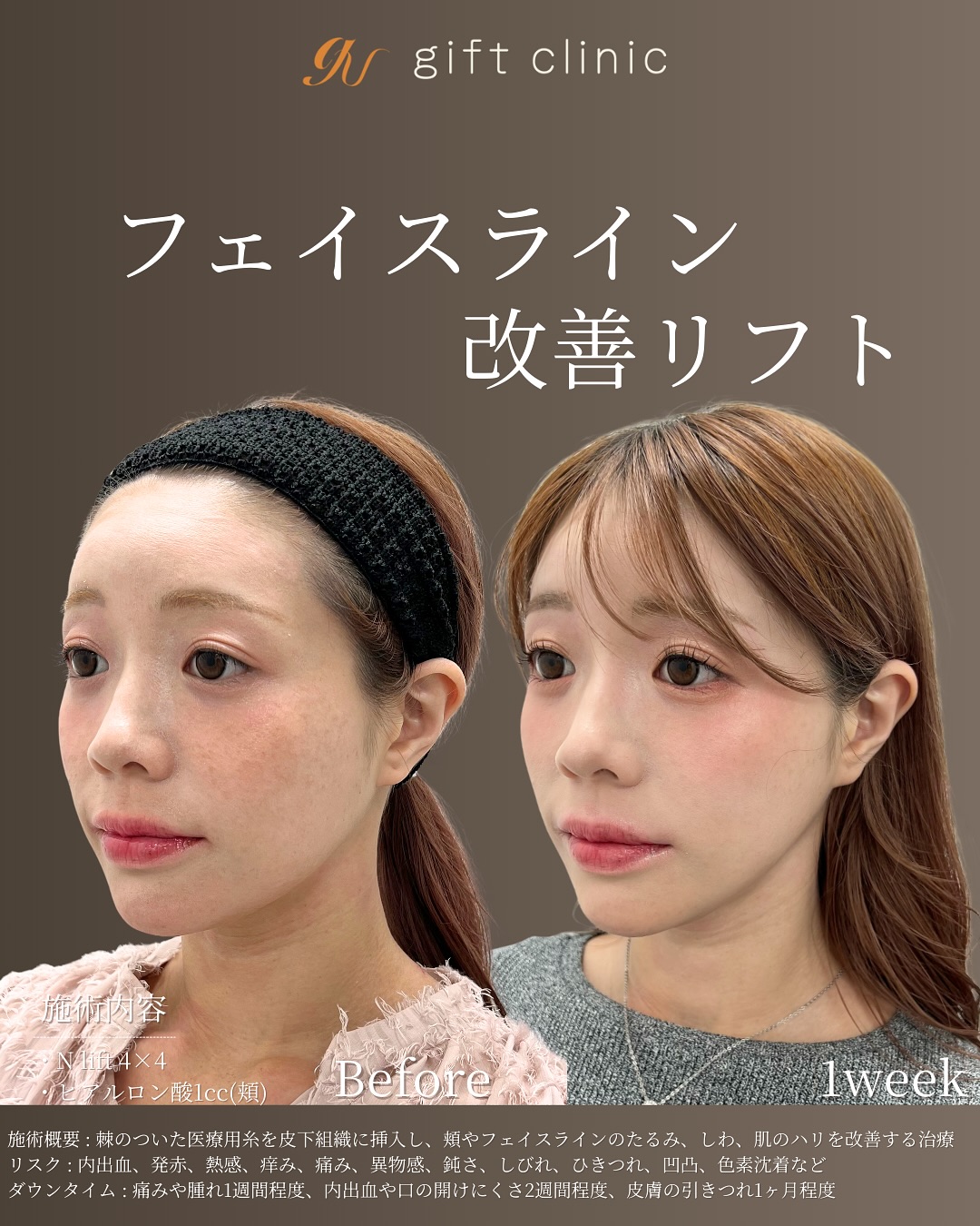 フェイスライン改善リフト Before/After