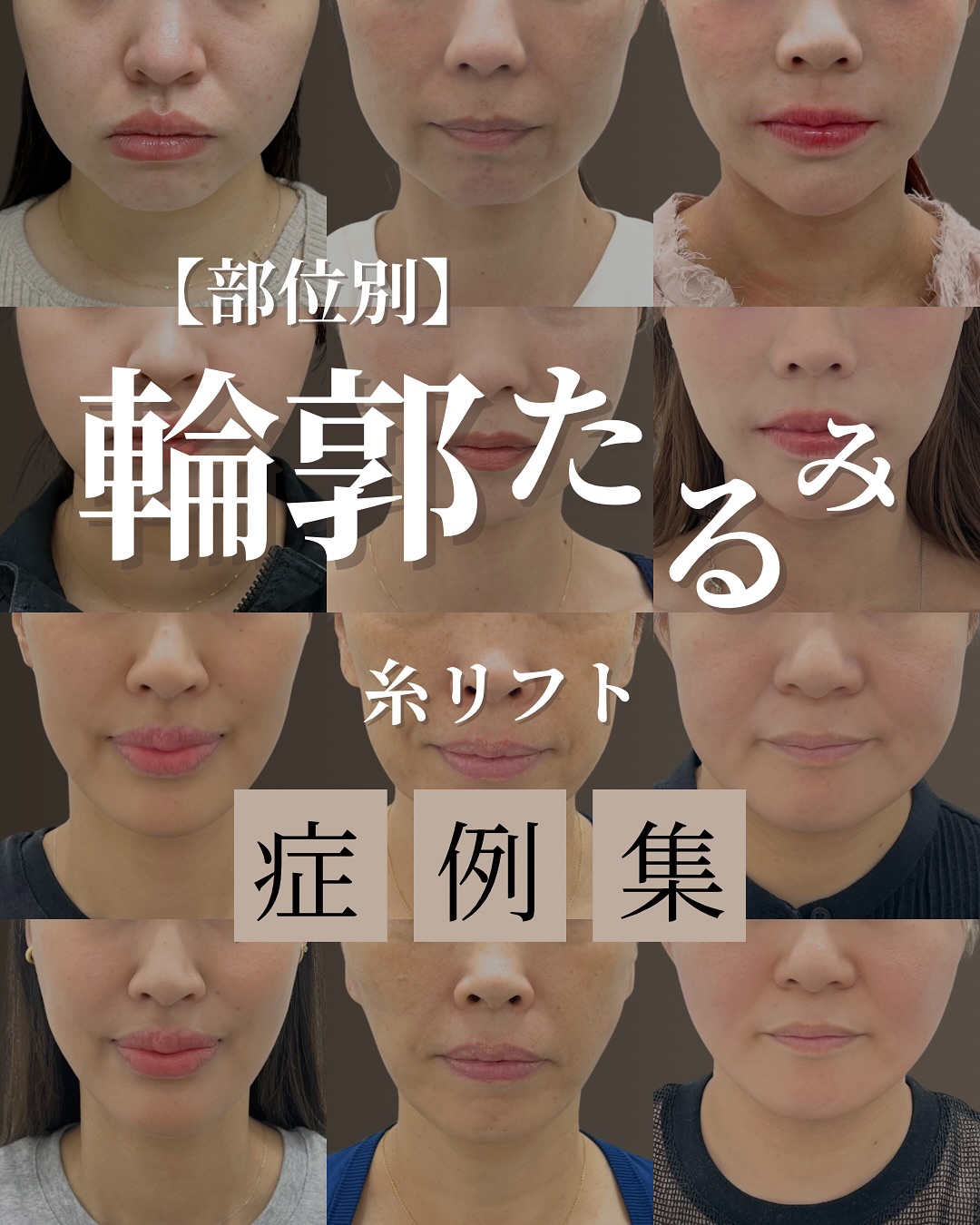 輪郭たるみ症例