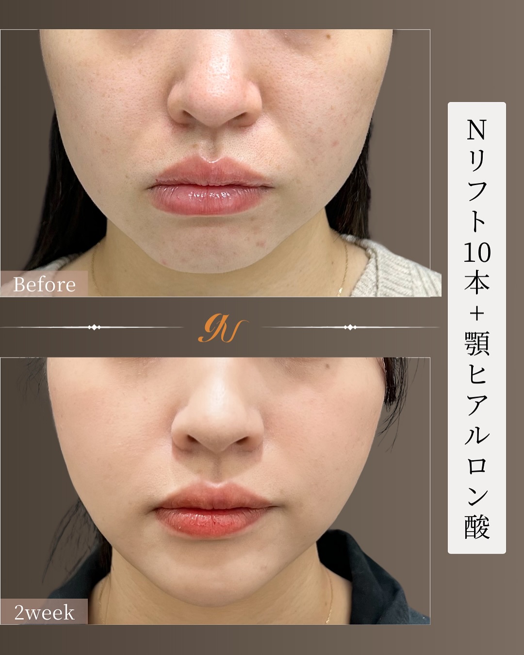 輪郭たるみ改善 Before/After