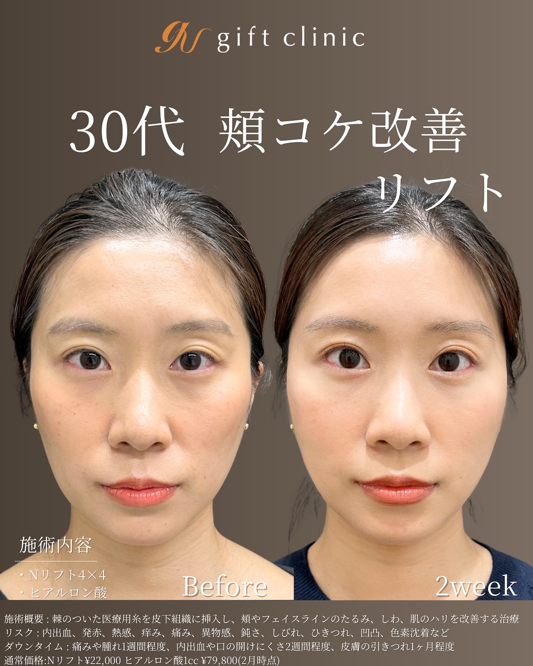 30代 頬コケ改善リフト Before/After