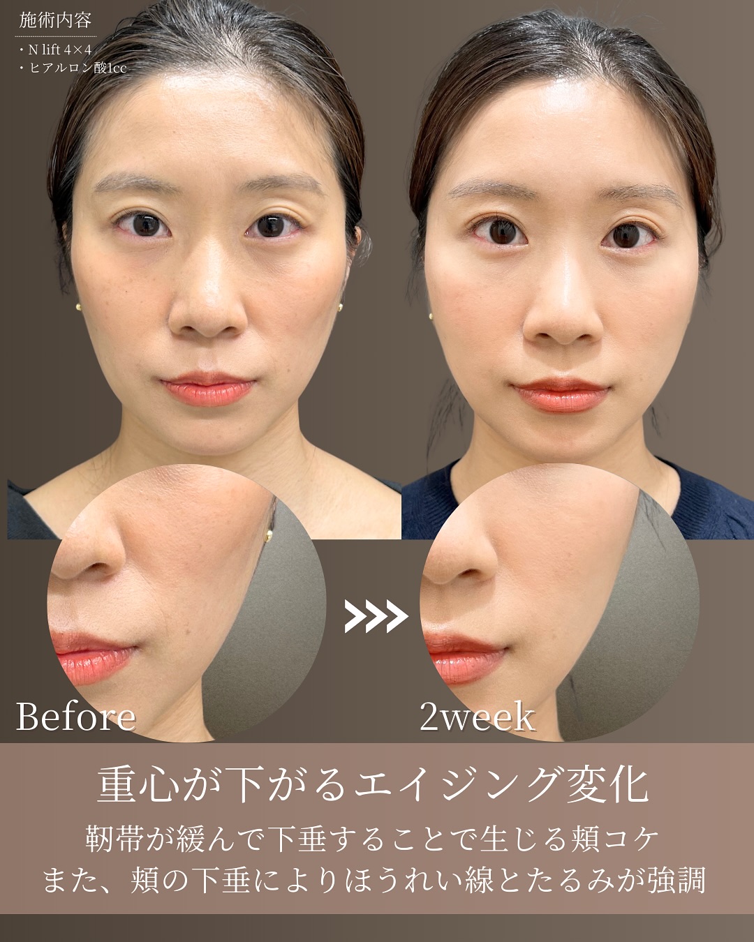 頬コケ 靭帯下垂からの改善