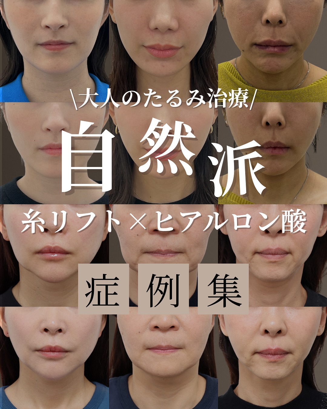 大人のたるみ症例