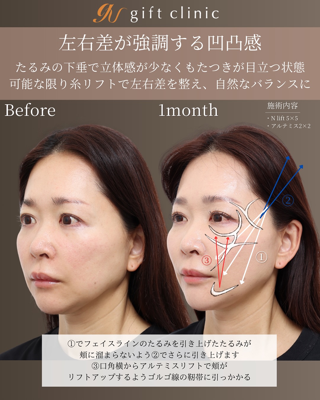 左右差改善リフト Before/After