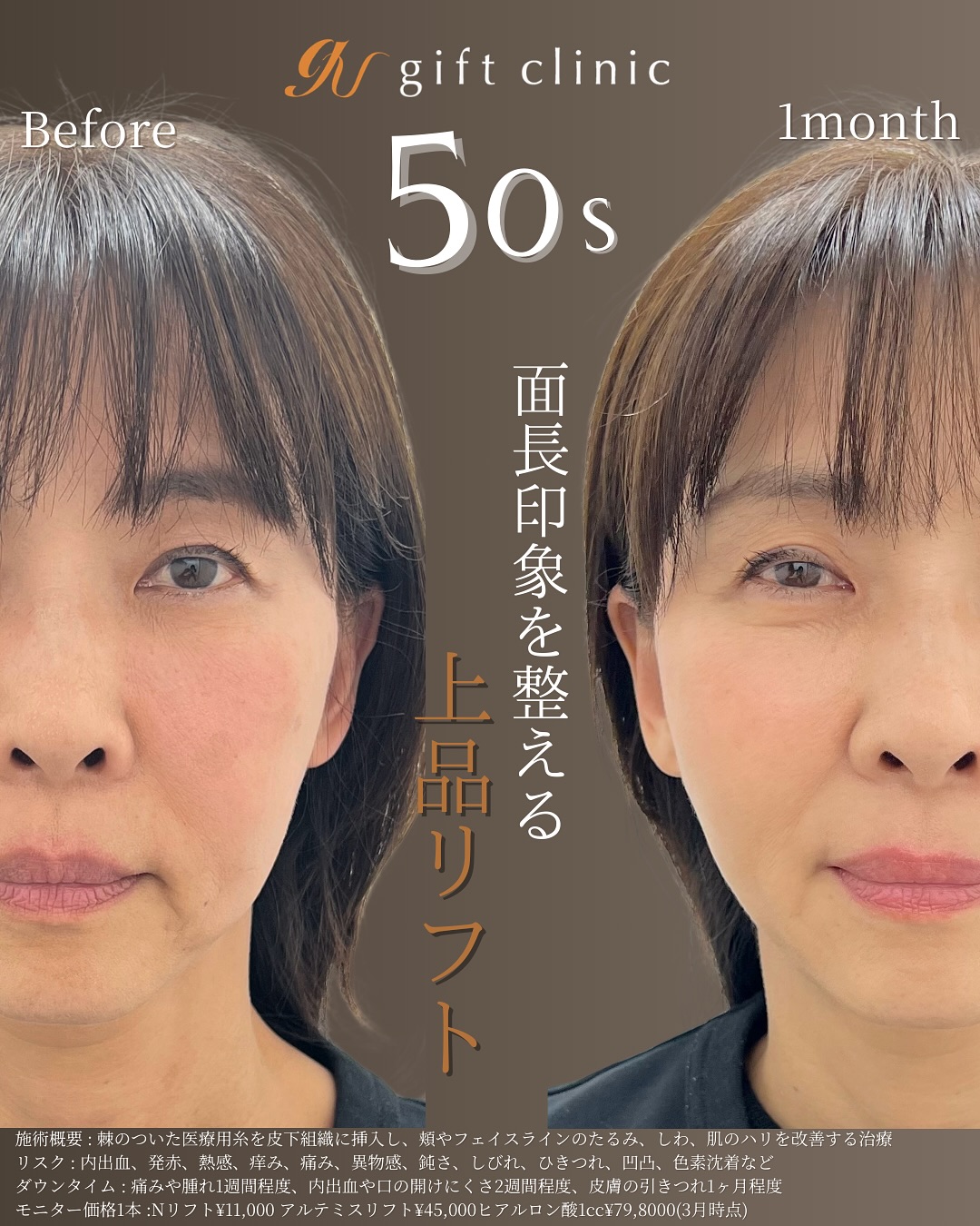 50代 面長印象を整える上品リフト Before/After