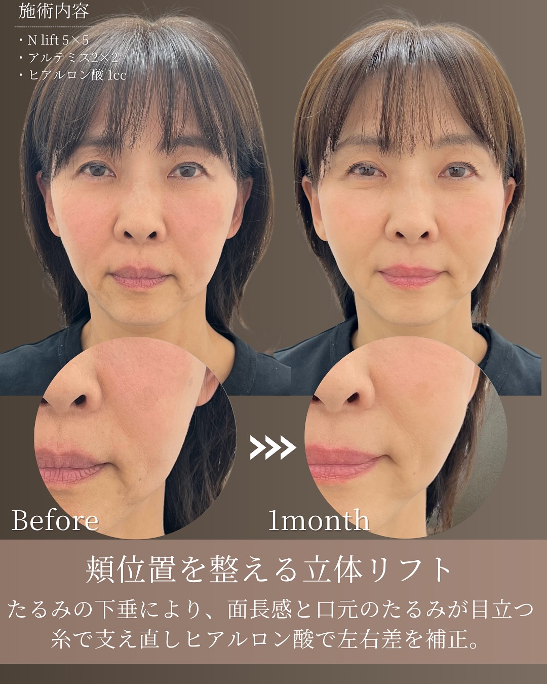 頬位置を整える立体リフト Before/After