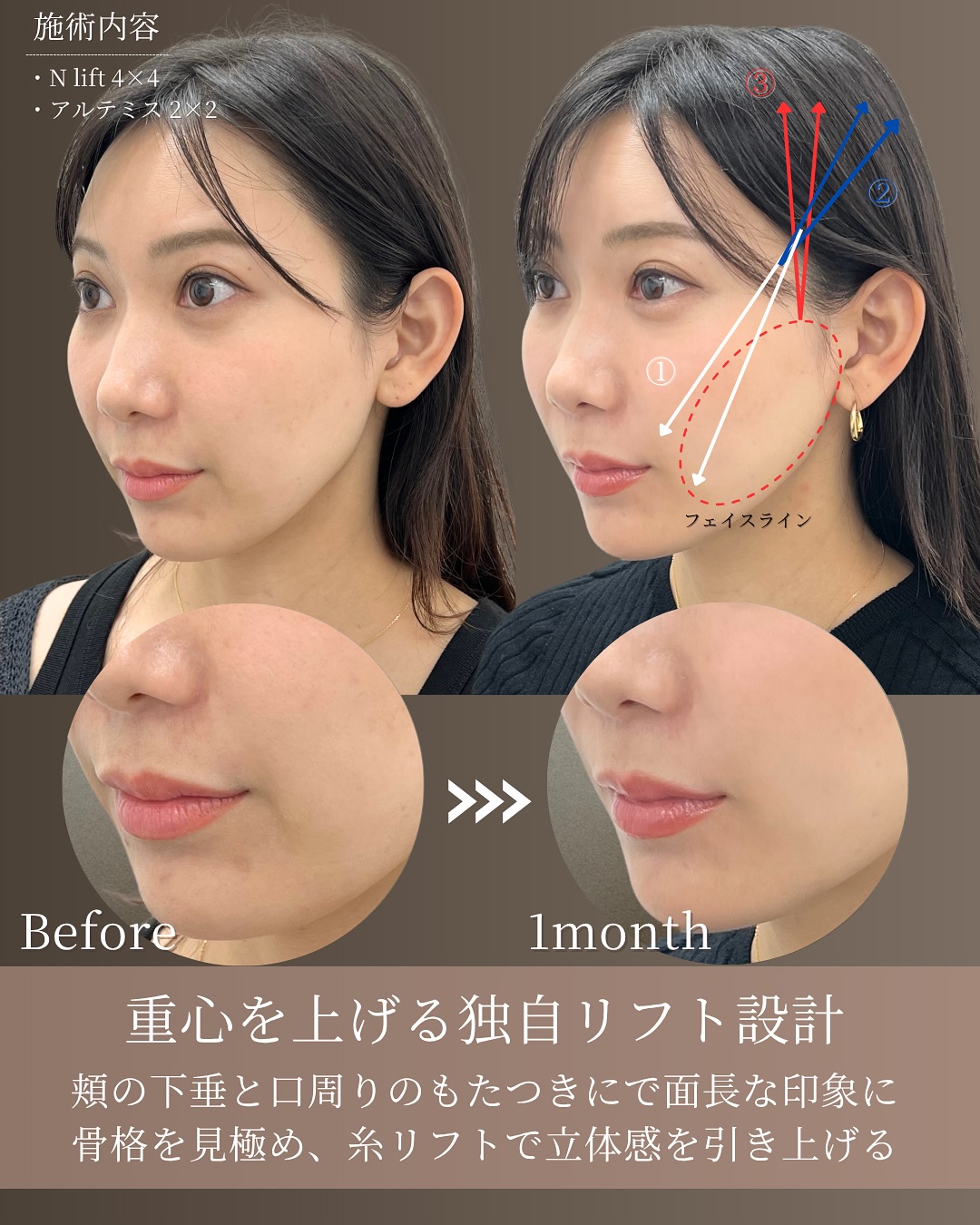 重心を上げる独自リフト設計 Before/After