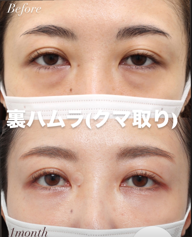 裏ハムラ施術1ヶ月後