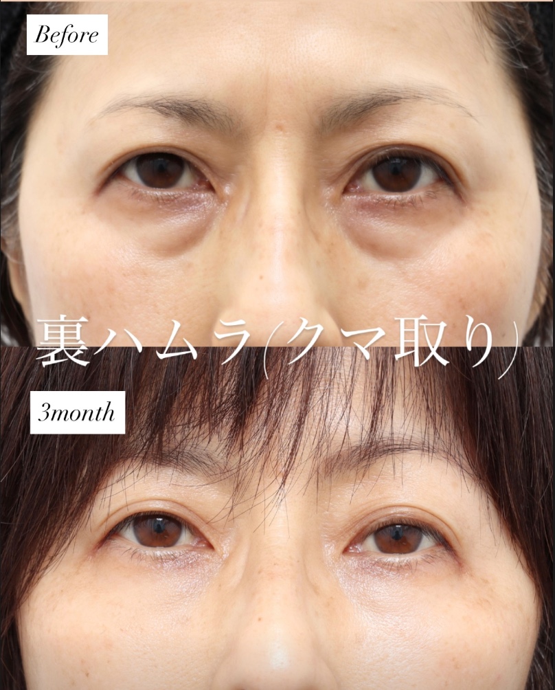 裏ハムラ法 3ヶ月後