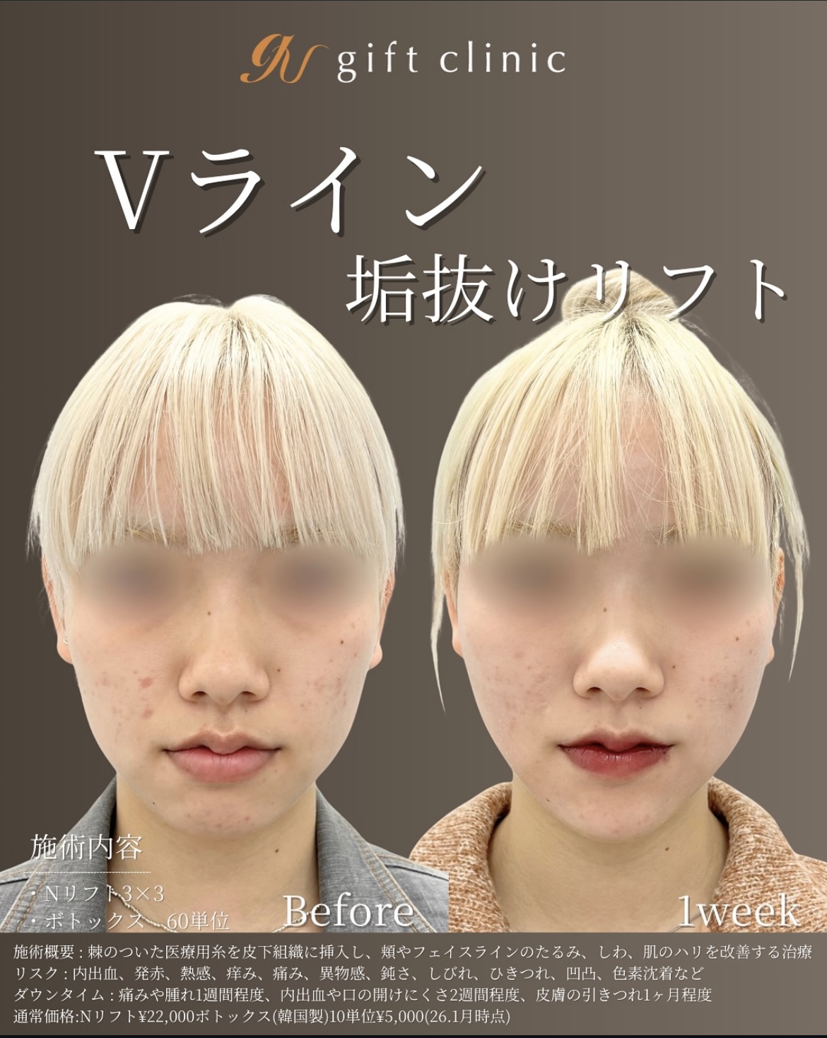 症例1-1 Vライン垢抜けリフト Before/1week