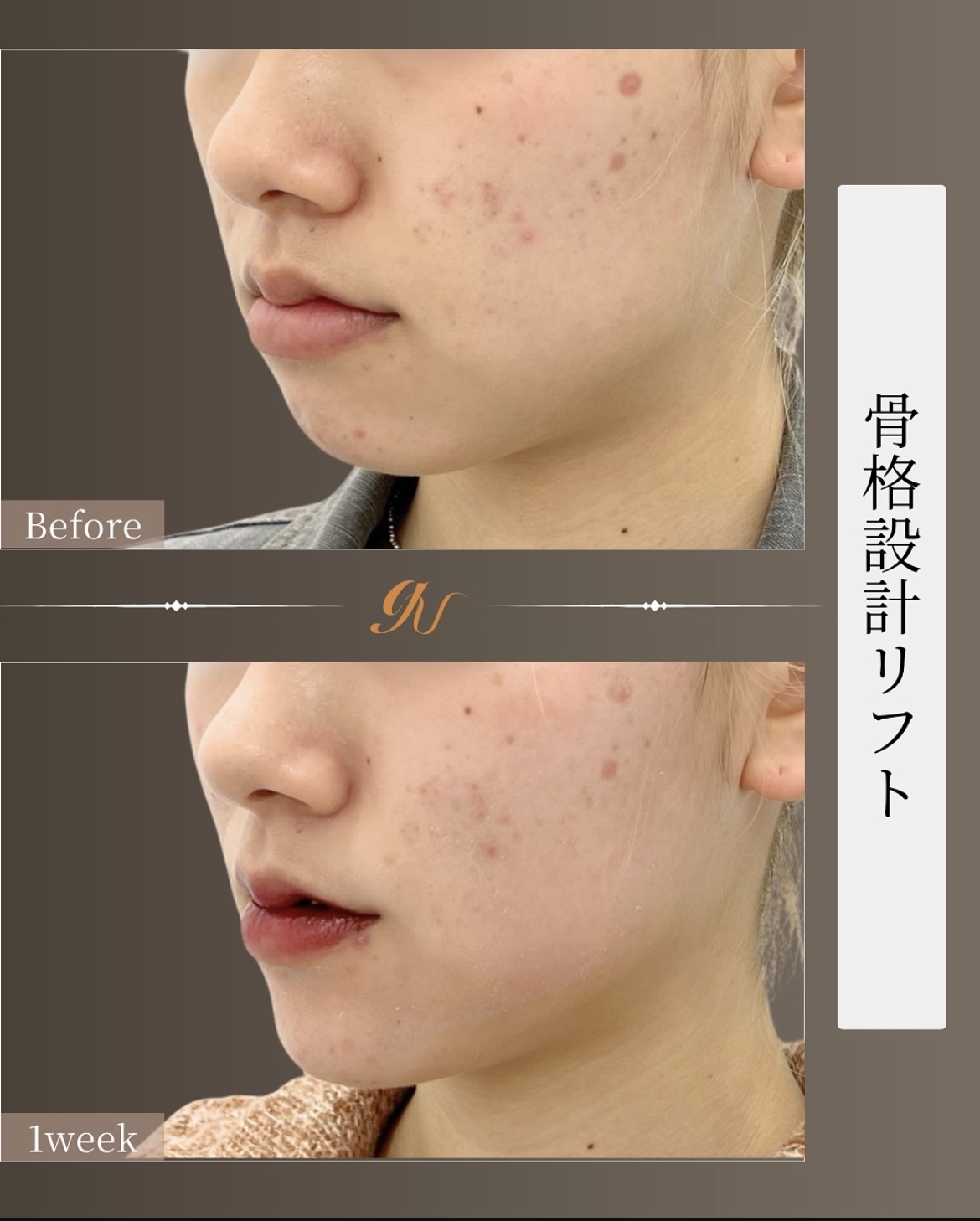 症例1-2 骨格設計リフト Before/1week