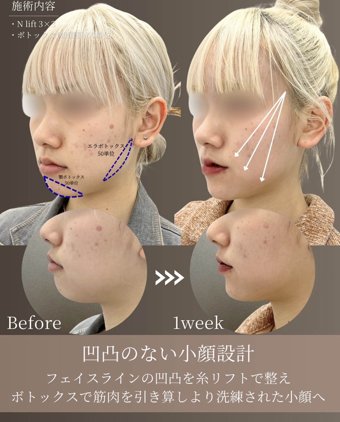 症例1-3 凹凸のない小顔設計 Before/1week