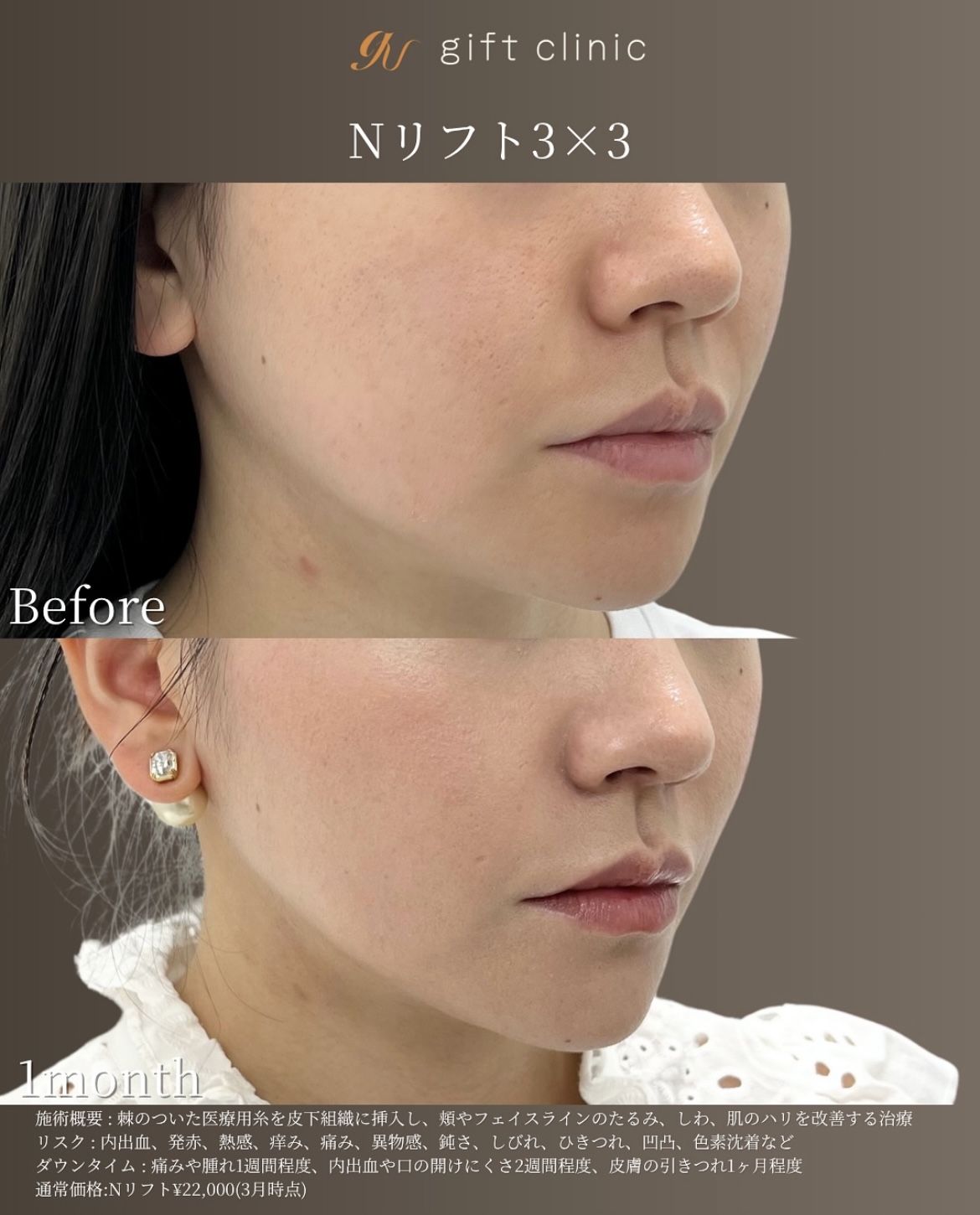 症例2-1 Nリフト3×3 Before/1month