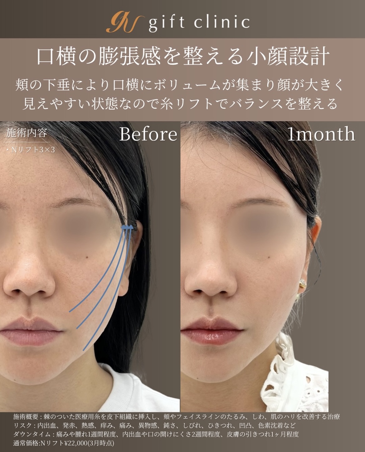 症例2-2 フェイスラインの膨張感を整える小顔設計
