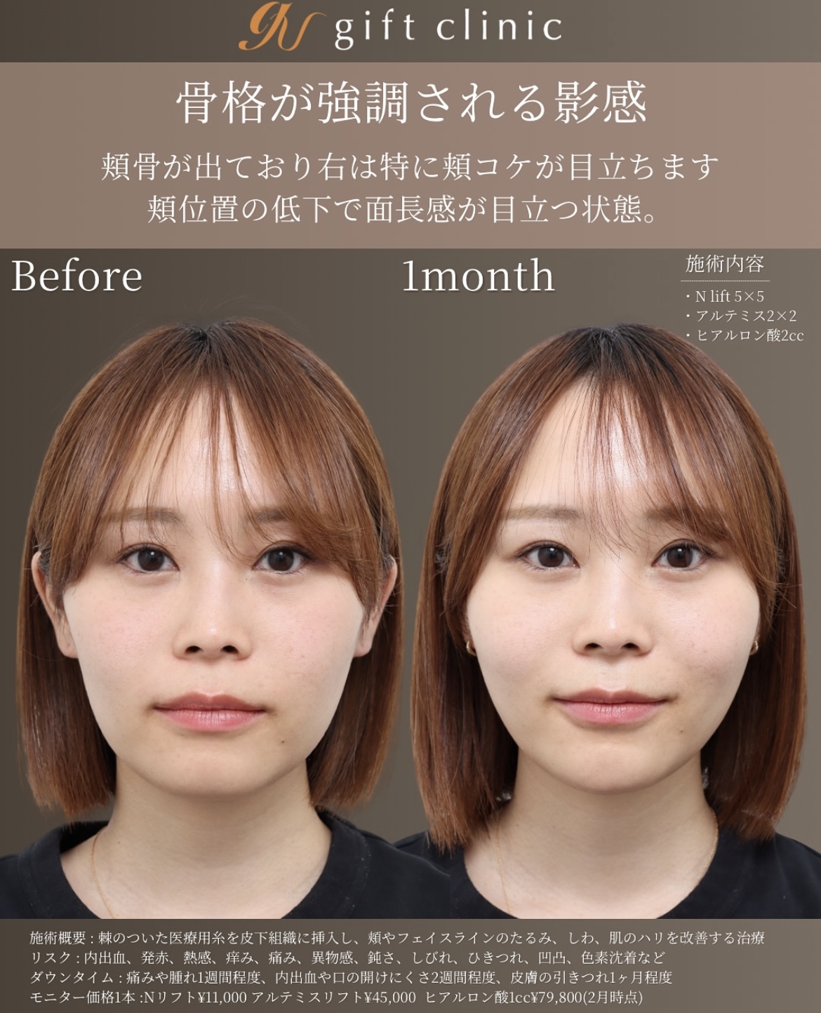 症例3-1 骨格が強調される影感 Before/1month