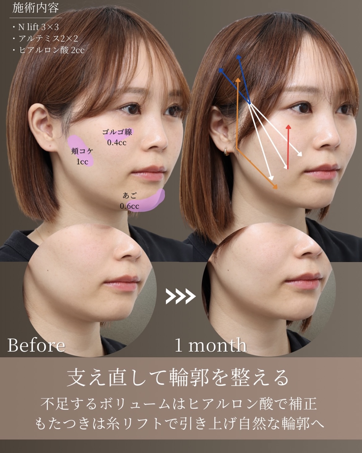 症例3-2 支え直して輪郭を整える